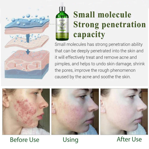 MUICIN - Tea Tree Anti Aging Clear Skin Face Serum - Age-Defy Clarity