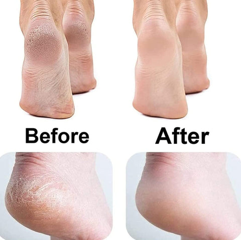 Home.Co- Callus Remover
